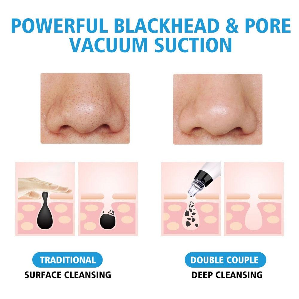 HailiCare™ - Premium Blackhead Remover